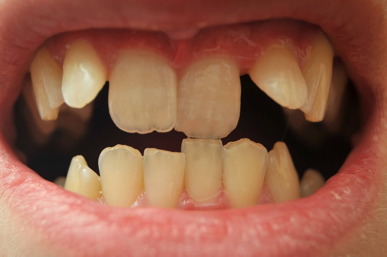 Can Composite Bonding Fix Crooked Teeth?
