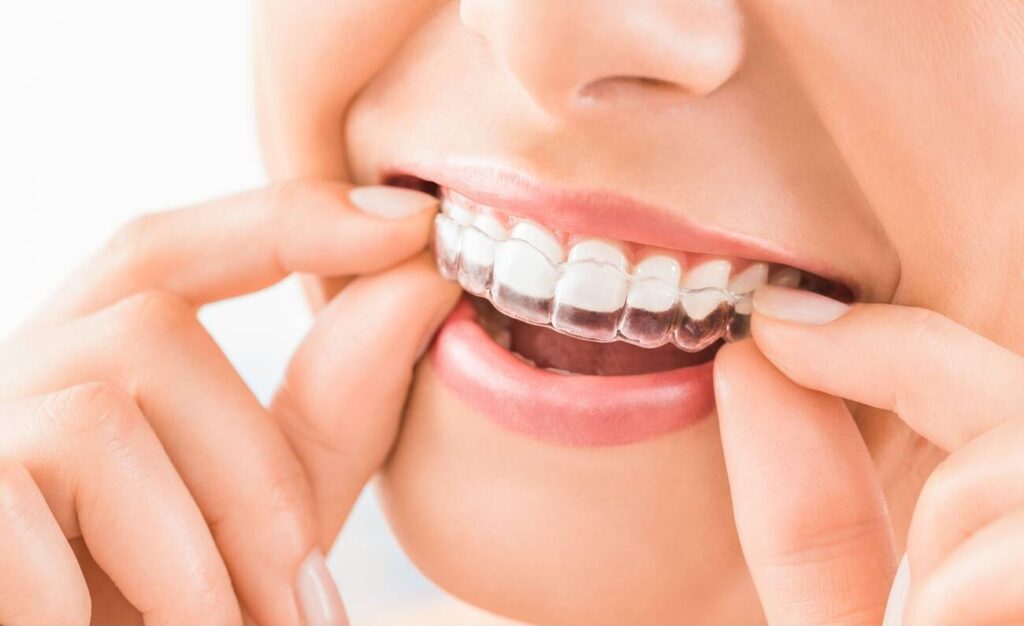 Can I Get Dental Bonding Instead of Braces?