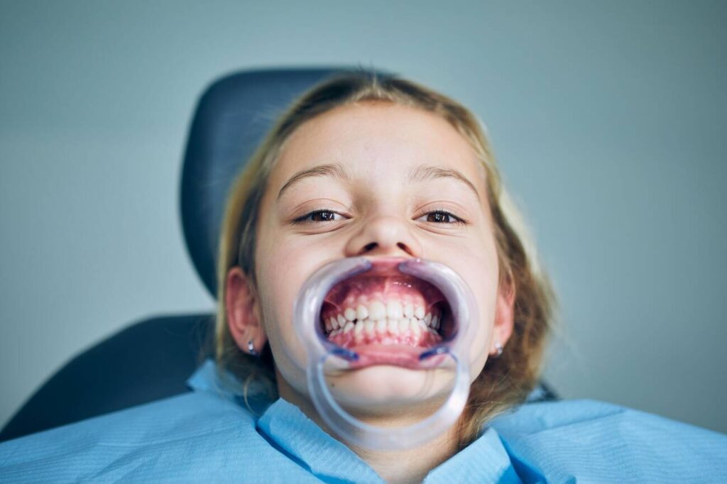 Can You Eat After Composite Bonding?
