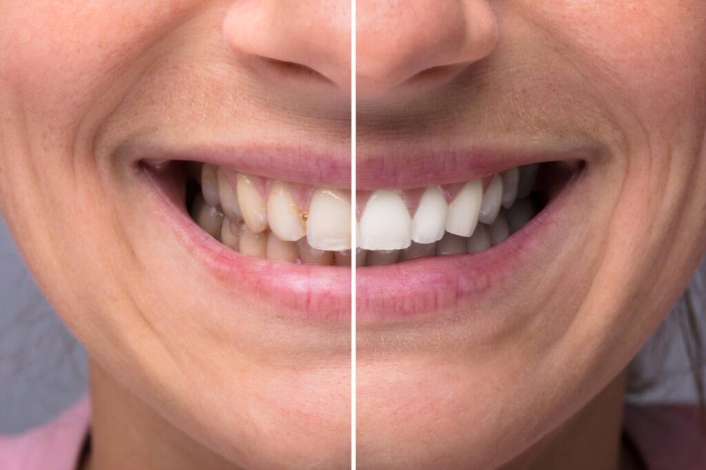Can You Whiten Composite Bonding?