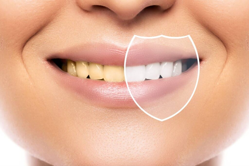 Is Composite Bonding Bad for Your Teeth?