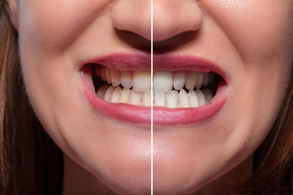 Is Teeth Bonding Safe and Permanent