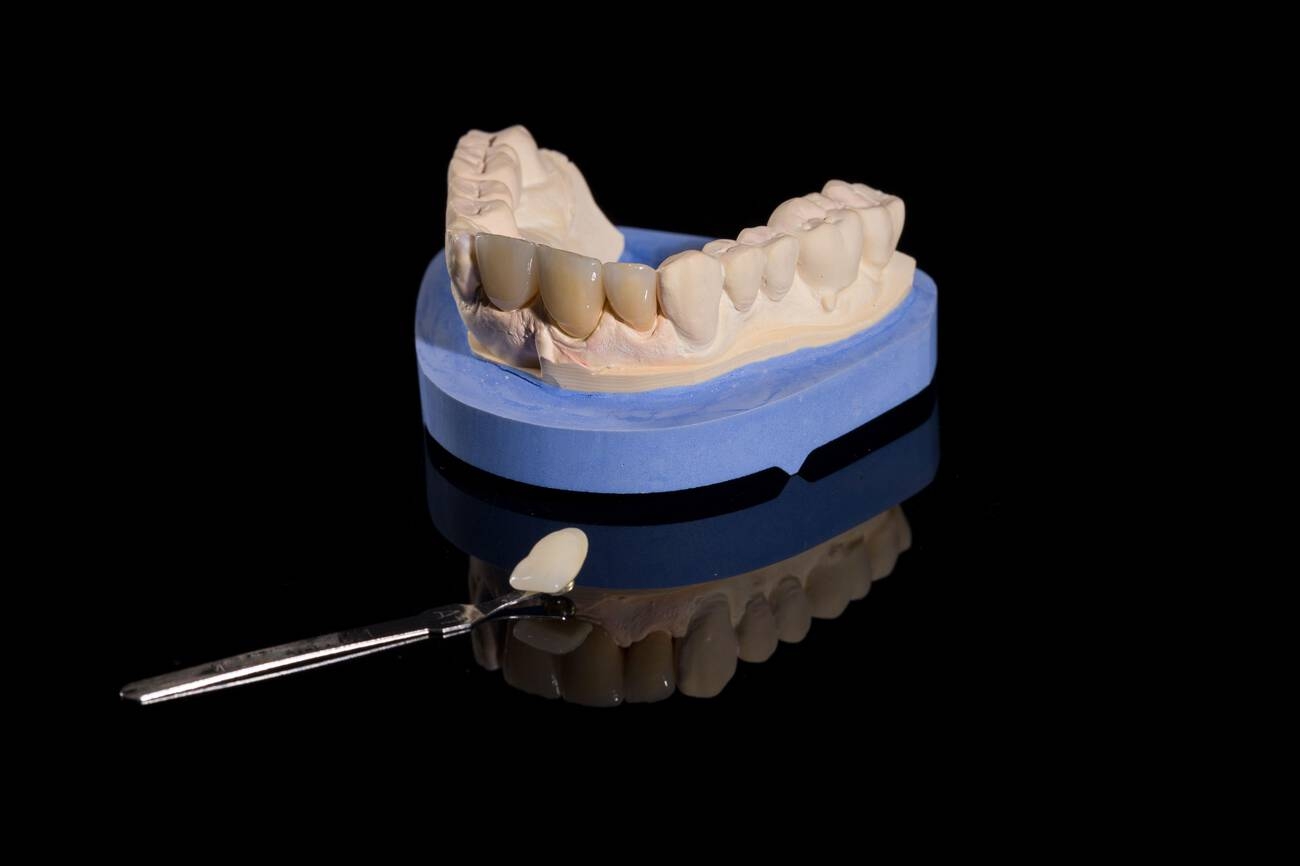 Teeth Bonding VS Veneers: Which is Right for You?