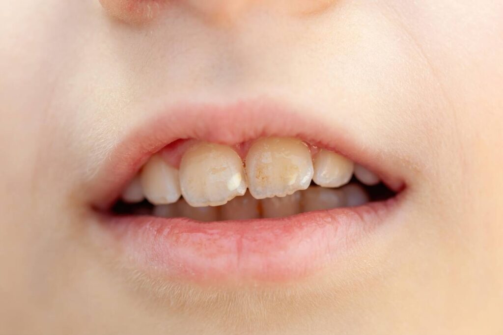 Can dental composite bonding cover severe fluorosis?