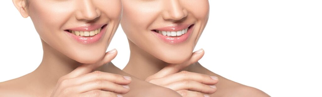 Composite Bonding After 5 Years – What London Patients Need to Know