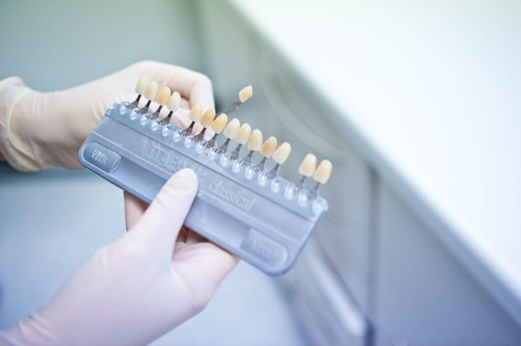 What Is a Composite Bonding Colour Chart?