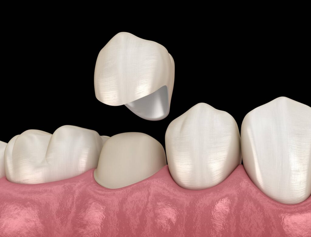 How Long Do Dental Crowns Last?