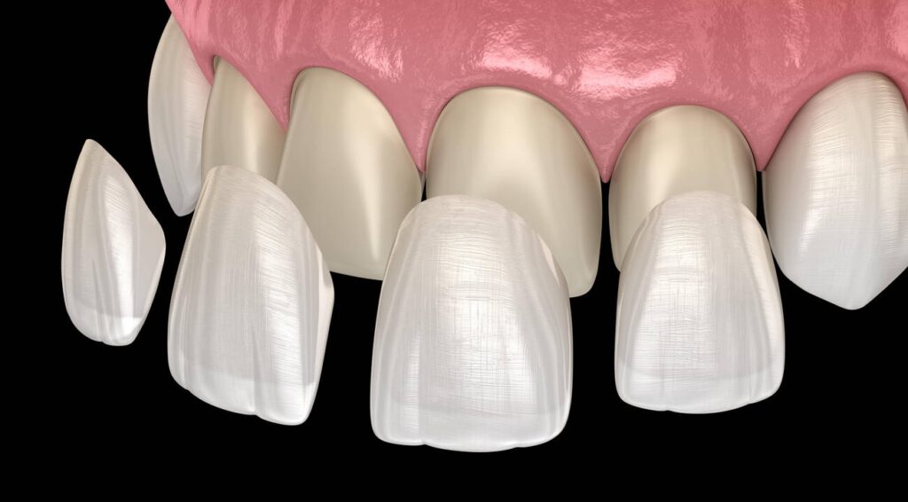 Can a Bonded Tooth Be Rebonded