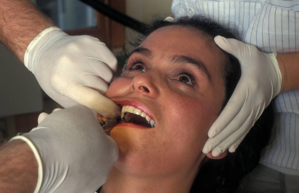 Can composite bond to existing amalgam fillings