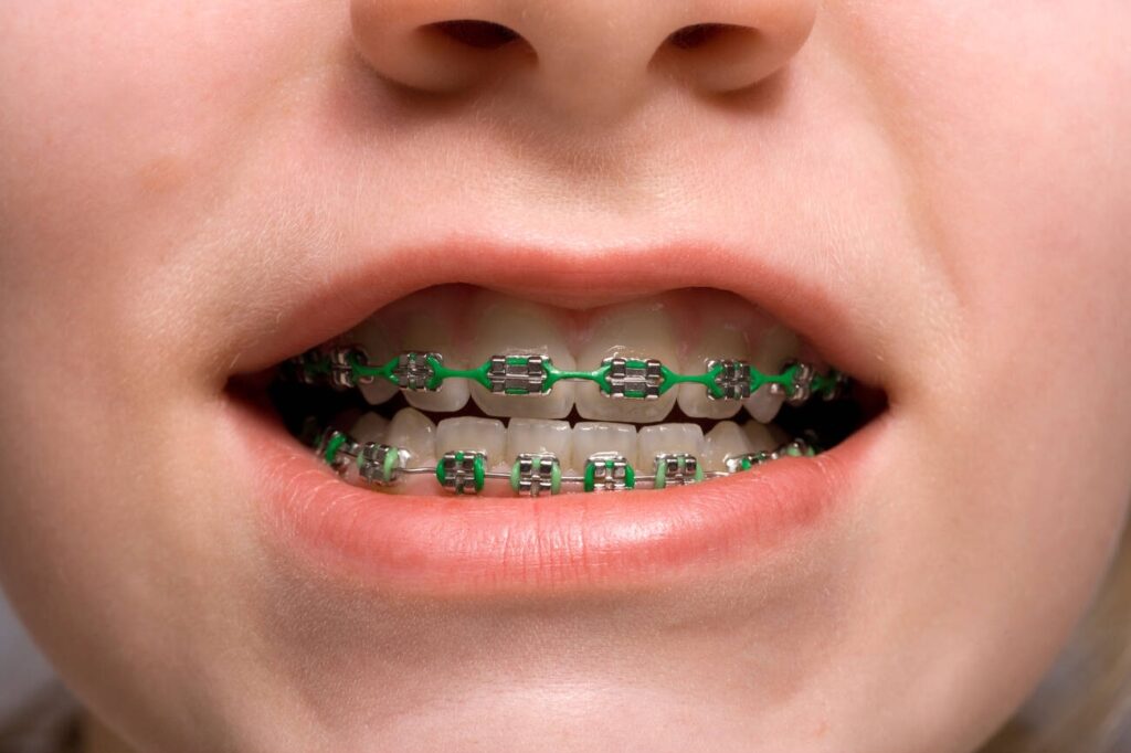 Can composite bonding be used instead of braces for gaps