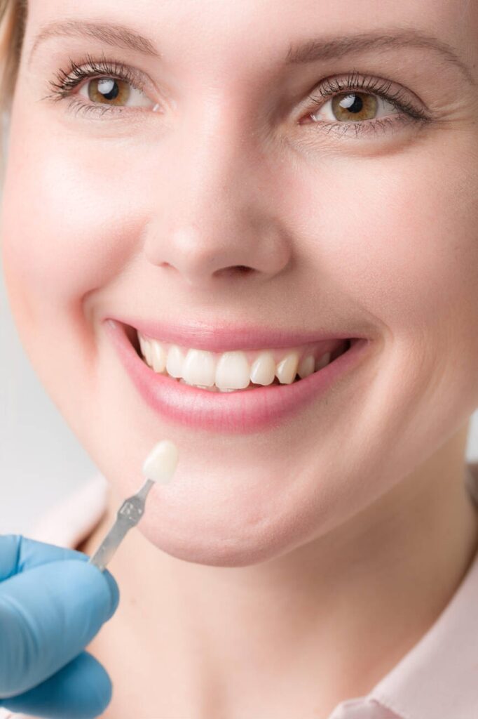 Can you whiten veneers crowns?