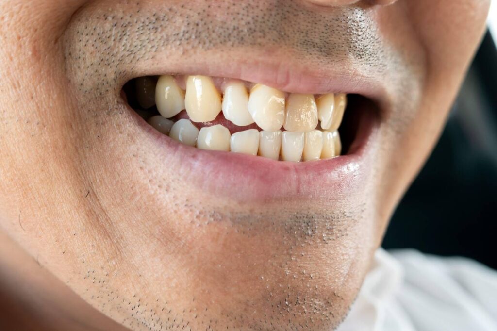 Does Bonding Stain Easily