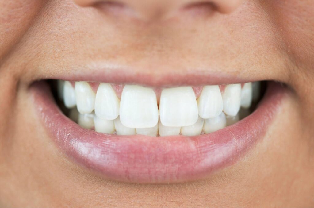 How long does professional teeth whitening last?