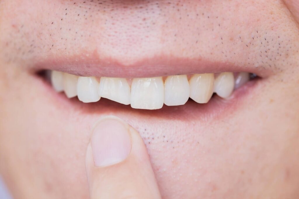 How to Fix a Broken Bonded Tooth