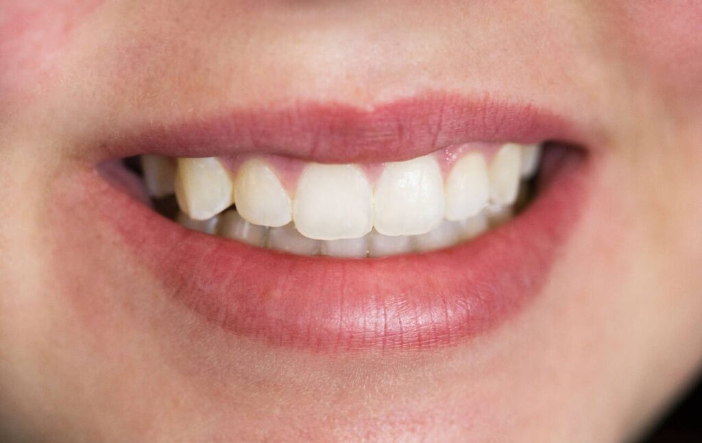 How to treat burned gums from teeth whitening?