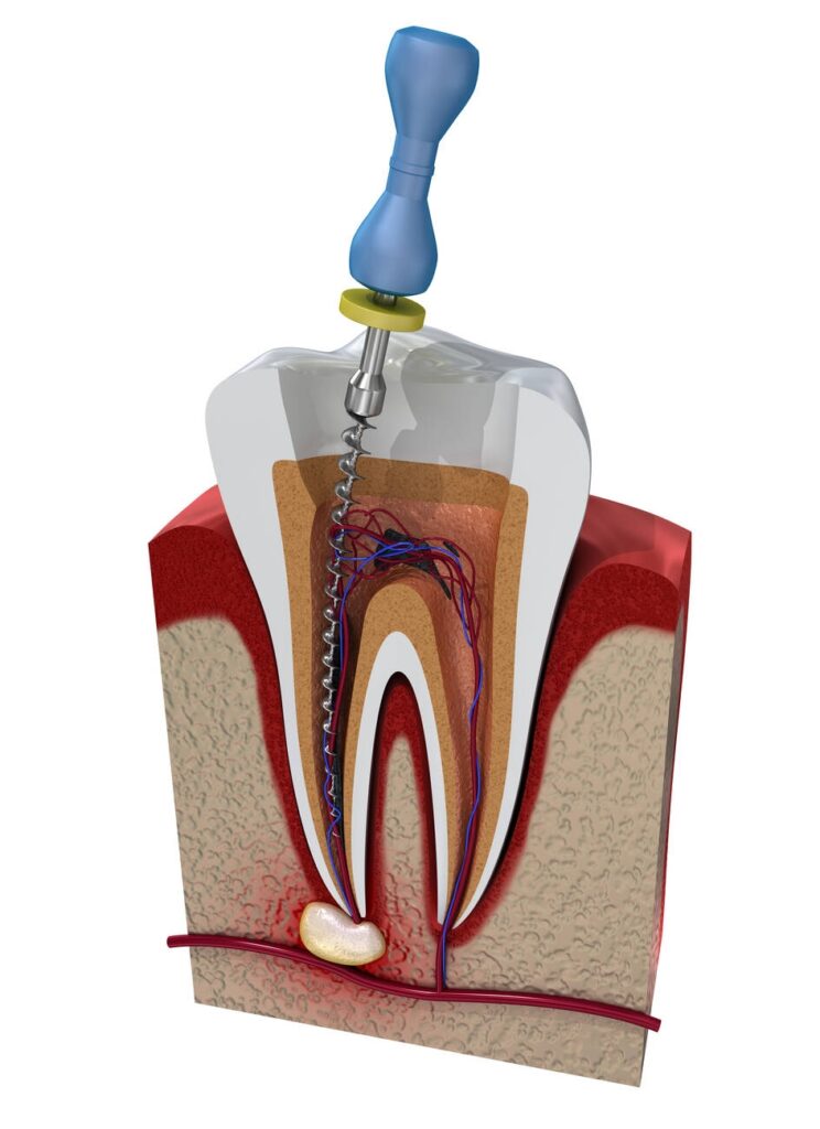 What is Root Canal Treatment