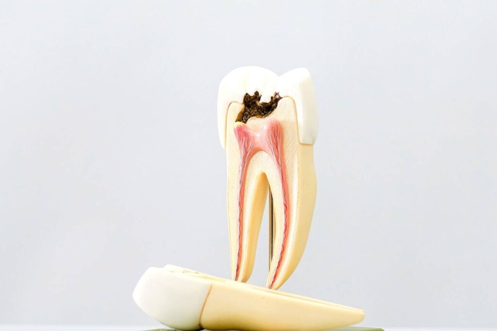 what causes root canal