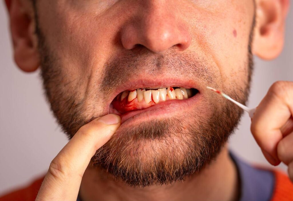 Why Do My Gums Bleed When I Floss?