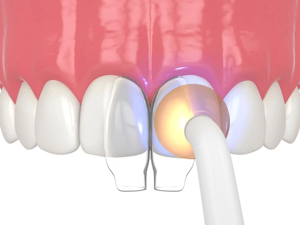 Composite Bonding or Crowns: Which Fits Best?