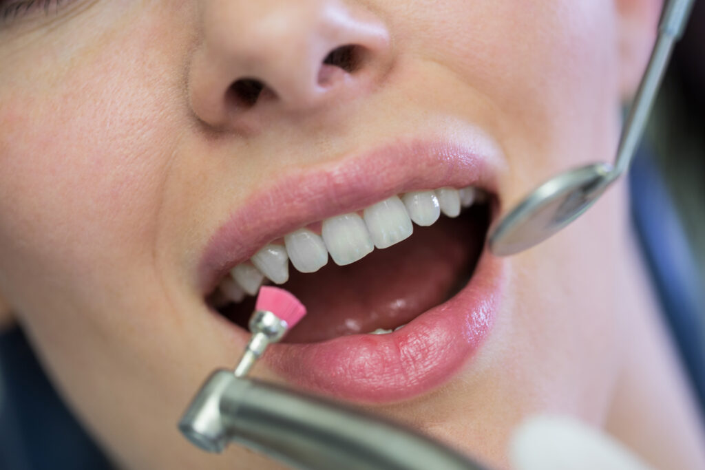 Composite Bonding vs Lumineers: Which Suits You?