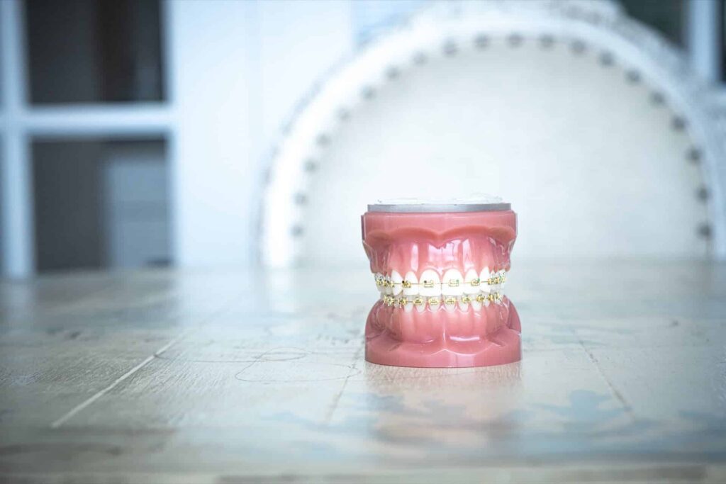 Composite Bonding vs Braces : What to Choose?
