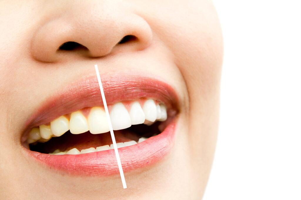 Composite Bonding vs Teeth Whitening : Which Is Better?
