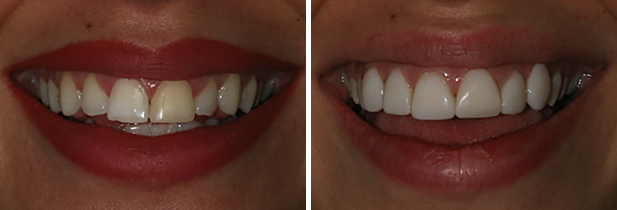 Composite Bonding London