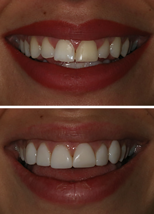 Before-After