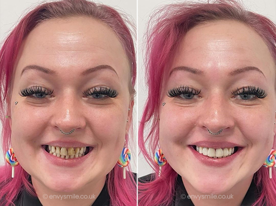 successful composite bonding case 1
