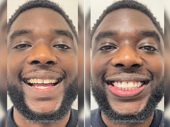 successful composite bonding case 2
