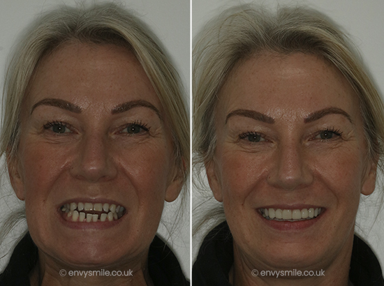 successful composite bonding case 3